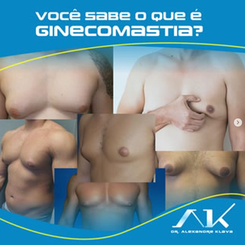 Ginecomastia